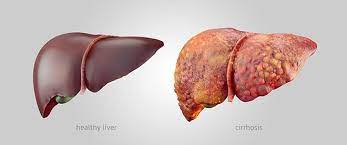 Fight Against Liver Disease